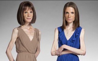 Anorektisten identtisten kaksosten järkyttävä kisa: Kumpi on laihempi